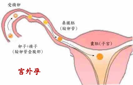 宫外孕对女性的危害