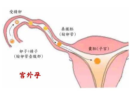 女性宫外孕有哪些表现