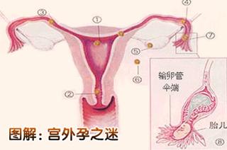 如何判断女性患了宫外孕