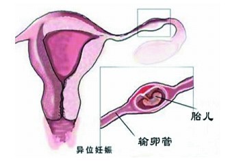 女性宫外孕b超检查