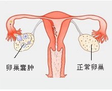 卵巢肿瘤常见都有哪些并发症呢